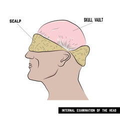Autopsy, preparation of the brain vault for incision.