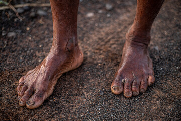 A man's feet are covered in mud and dirt.