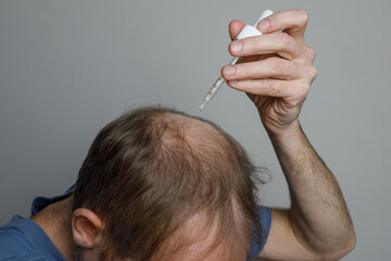 Mature man applying hair loss serum or minoxidil on bald scalp