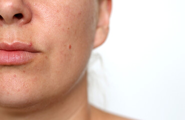 Close up of female face with red problematic acne skin and scars