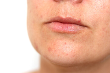 Fototapeta premium Close up of female face with red problematic acne skin and scars