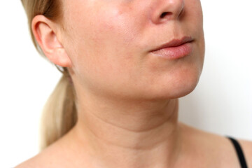 Obraz premium Close up of caucasian female face with healed acne skin