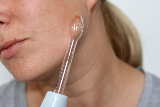 Close up of woman using a high frequency darsonval device on acne skin