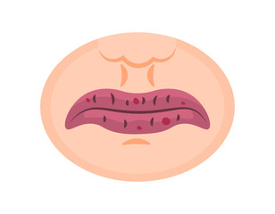 illustration of dry and sore lips. chapped lips, irritation or rash. mouth or lip disease. ulcer. health problems. flat style design. graphic elements