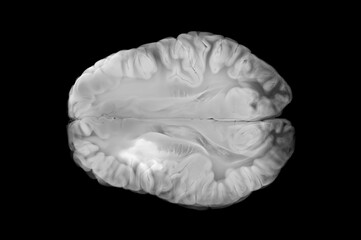 Brain MRI Showing Ischemic Stroke with Barrier Penetration