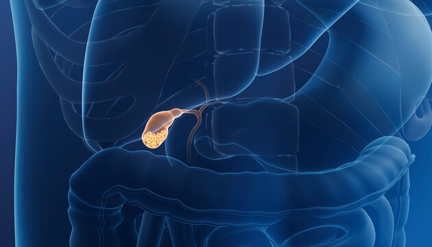 Gallstones in human gallbladder, 3d illustration