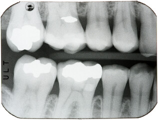 Dental X-rays of teeth in the back of the mouth, showing bright fillings where cavities and decay had been found.