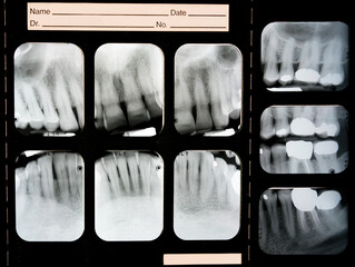 A panel of nine dental x-rays, brightly showing crowns, root canals, and fillings where cavities and decay had been found.