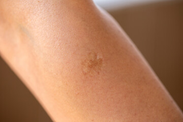  The woman has big scar from smallpox vaccine on her arm