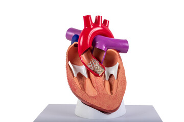 Cardiac model of Transcatheter aortic valve implantation (TAVI) for people education. Heart...