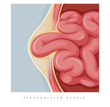Strangulated Hernia -  Section of the Small Intestines - Stock Illustration