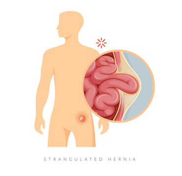 Strangulated Hernia -  Section of the Small Intestines - Stock Illustration