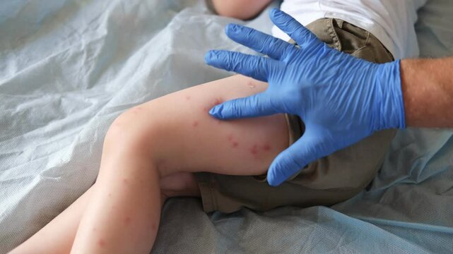 Doctor examining child with bodily red rash. Kid allergy closeup. Little baby scratches an eruption. Nurse applies special cream to atopic skin. Dermatitis, irritation, hive. Pruritus. Mosquito bites