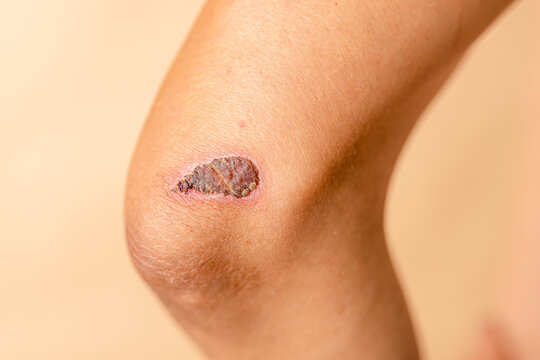 Healing process of a scab on an elbow, captured in natural light, emphasizing the skin texture and details of the wound