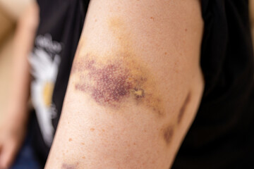 Large bruises on the arm of human from accident