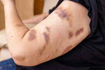 Fototapeta premium Large bruises on the arm of human from accident