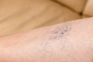 Close-up of a bruise on a woman's leg. A bruised leg