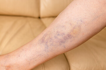 Close-up of a bruise on a woman's leg. A bruised leg