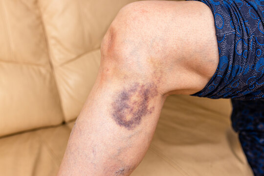 Close-up of a bruise on a woman's leg. A bruised leg