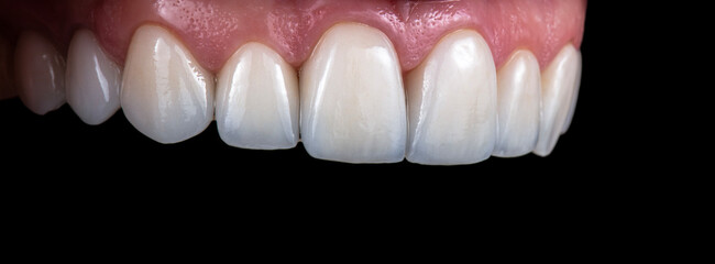 ceramic crowns and veneers