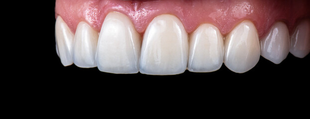 ceramic crowns and veneers