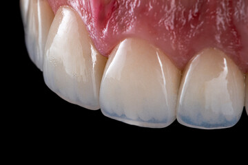 emax ceramic crowns and veneers
