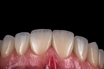 emax ceramic crowns and veneers