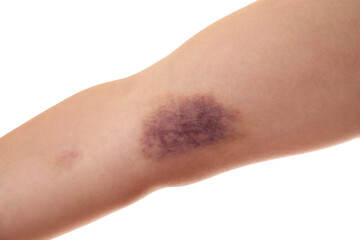 Woman with bruise on arm against white background, closeup