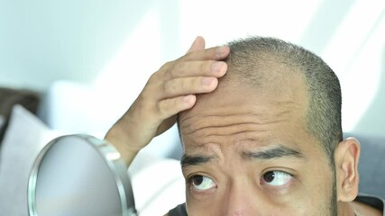 Asian man having stress about his hair loss problem. Baldness is related to your genes and male sex hormones.