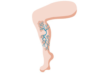 A venous leg ulcer is a chronic, slow-healing sore on the lower leg caused by poor blood circulation due to venous insufficiency. Related diseases: varicose veins,deep vein thrombosis, lymphedema