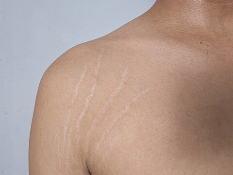 stretch marks on armpit skin area