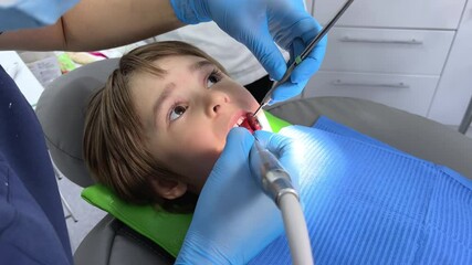 A doctor dentist in a medical mask and blue rubber gloves puts a seal on a little boy toddler. Caries treatment Examination with dental mirror, pediatric dentistry. Professional teeth cleaning.