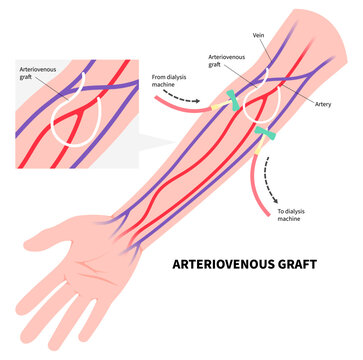 Vascular access surgery for kidney disease with intravenous injection tube on arm blood vessel in medical