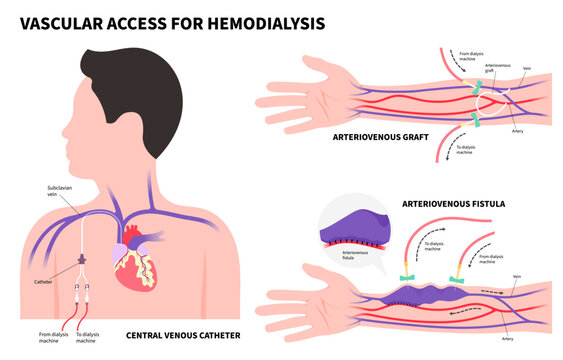 Types of Vascular access surgery for kidney disease with intravenous injection tube on arm blood vessel in medical care