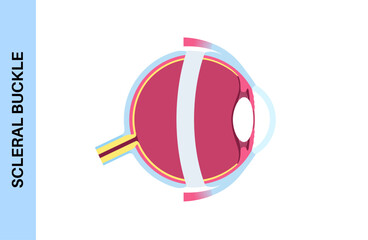 Scleral buckle procedure