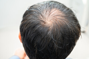 Fototapeta premium Bald in the middle head and begin no loss hair glabrous of mature Asian business smart active office man.