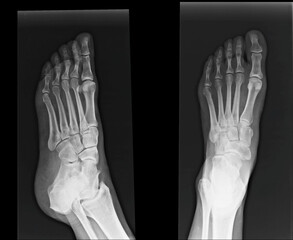 left foot xray
