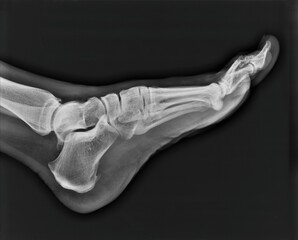 left foot xray