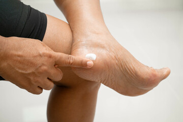 Asian woman applying moisturizing cream skincare treatment to solve and repair feet with crack and dry heel skin.