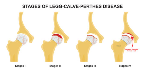 Stages of legg calve perthes disease illustration