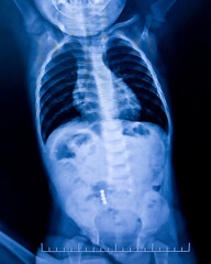 X-ray of a small child who swallowed 4 round magnets. Image of magnets in the digestive tract