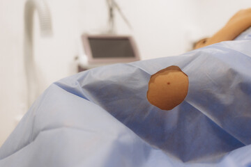 the surgeon surgically removes a mole - surgical removal of a mole -