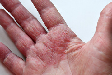 The skin on the palm and fingers is damaged, reddened, cracked and peeling. Dermatological diseases. Skin inflammation. Selective focus. close-up. Eczema, dermatitis, dermatosis, inflammation
