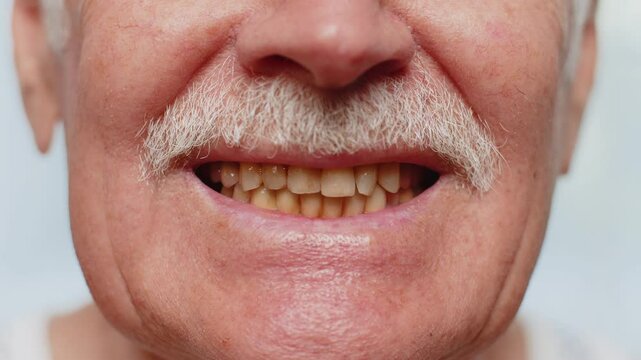 Close-up macro shot of senior elderly man smiling showing yellow teeth. Dental problem, bad teeth. Pensioner grandfather guy with white mustache showing rotten teeth, caries, decayed and weak enamel.