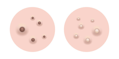 Blackheads and whiteheads Acne skin pimple, vector illustration