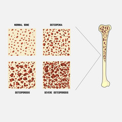 Deterioration of human bone, osteoporosis, osteopenia, severe osteoporosis.