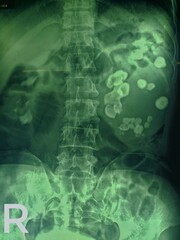 x ray image of a human abdominal pain 