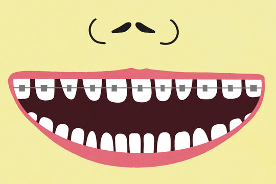 Smiling mouth showing dental braces on teeth