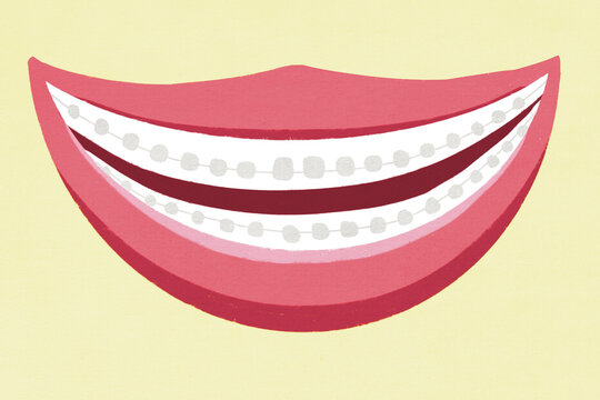 Illustration of smiling mouth with braces on teeth
