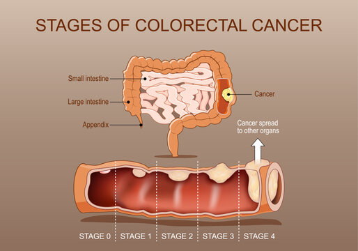 Stages of colorectal cancer